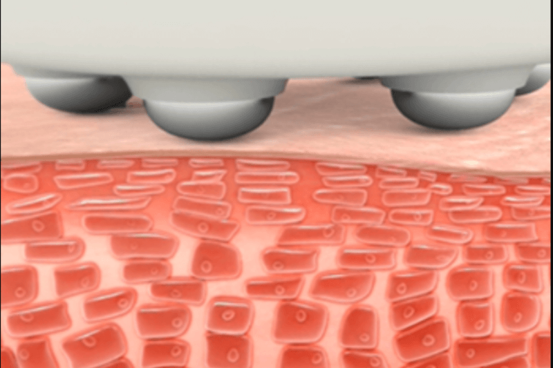 Electroporation technology used for needle-free mesotherapy